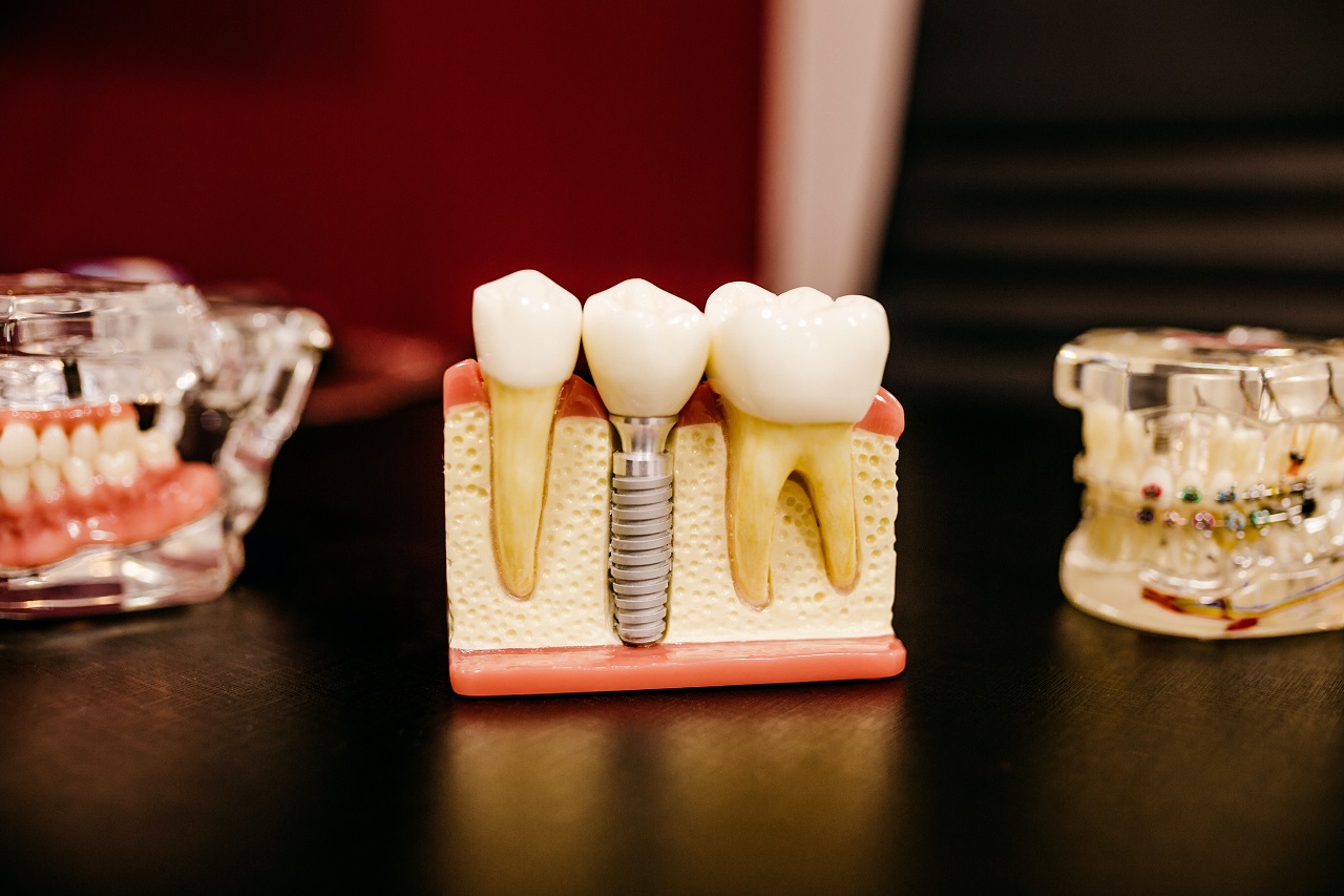 W jaki sposób stomatolodzy uzupełniają ubytki w uzębieniu?